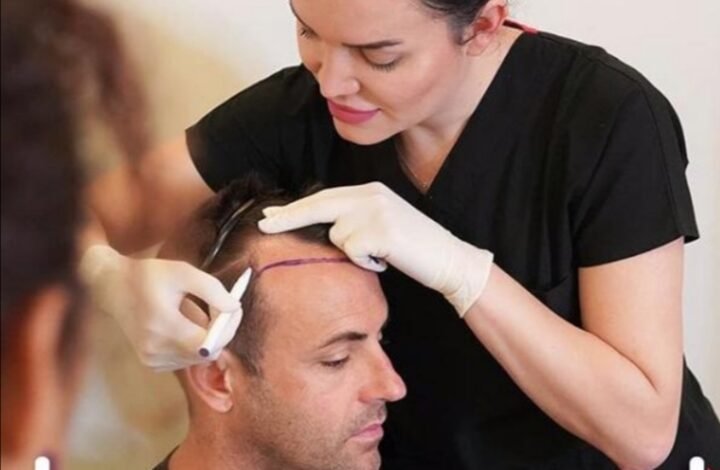 مركز Estepera واحدث تقنيات زراعة الشعر العالمية