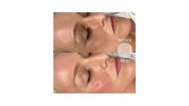 لا جراحة بعد اليوم.. مركز “The Carnaby Laser Clinic” يعالج مشاكل البشرة بتقنية الليزر