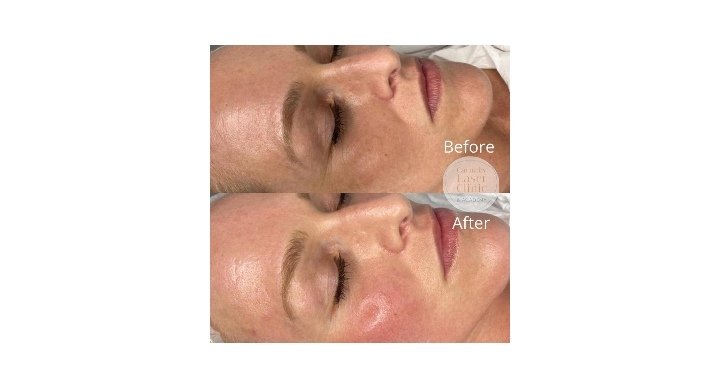لا جراحة بعد اليوم.. مركز “The Carnaby Laser Clinic” يعالج مشاكل البشرة بتقنية الليزر
