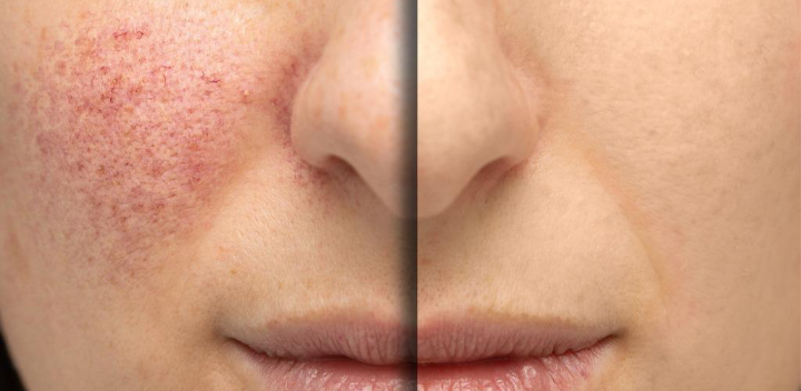 مركز “Carnaby Laser Clinic and Academy” في لندن يتميز بتقديمه العلاج الأفضل للأوردة العنكبوتية