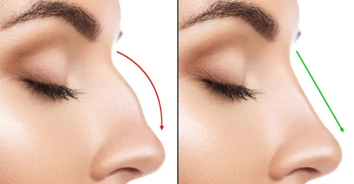 عمليات تجميل الأنف… مع دكتور التجميل “Ali Abedali”