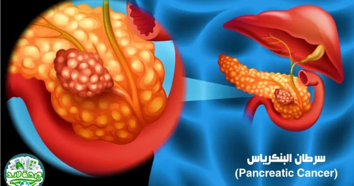 Revolution Medicines تحصل على موافقة أميركية لعلاج سرطان البنكرياس - صورة مميزة صورة مميزة: Revolution Medicines تحصل على موافقة أميركية لعلاج سرطان البنكرياس