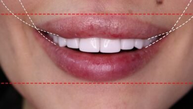 الدكتور Habib Zarifeh يبتكر تقنية جديدة لمحاربة الشيخوخة و تجميل الأسنان “Smile Lift”