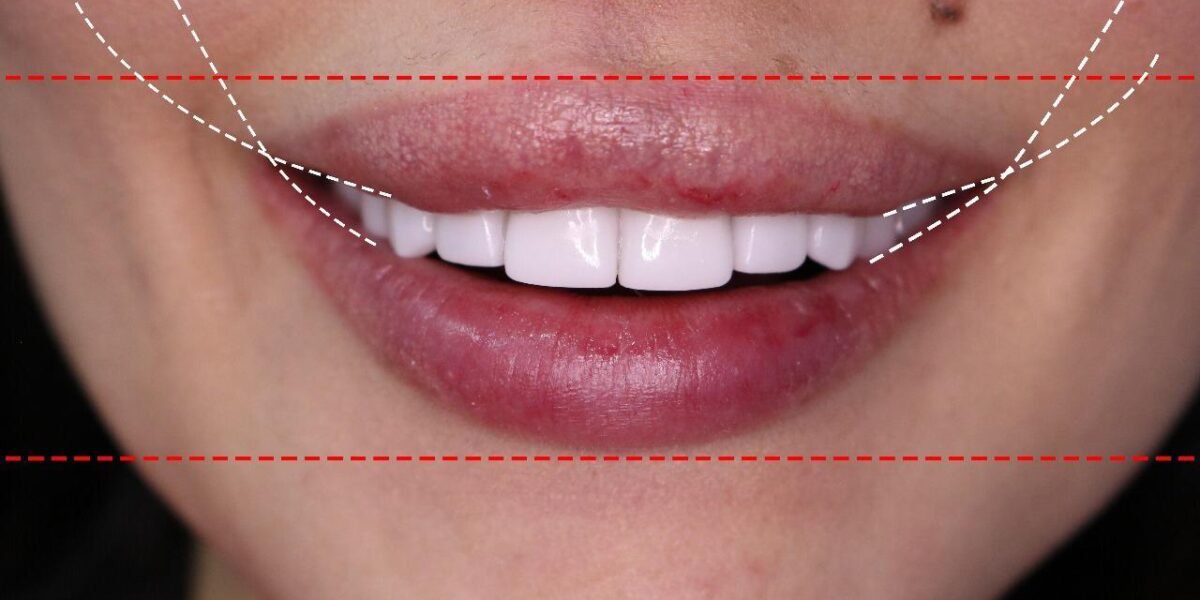 الدكتور Habib Zarifeh يبتكر تقنية جديدة لمحاربة الشيخوخة و تجميل الأسنان “Smile Lift”
