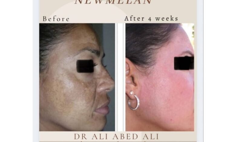 دكتور التجميل “ali abedali” يتحدث عن تقنية “newmelan pigmentation”