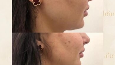 مركز “Dermanda Clinic” يقدم “HIFU-ULTRA SKIN II” لعلاج مشاكل الوجه وترهلات الجسد