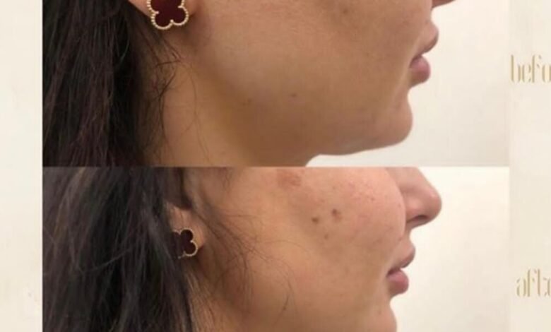 مركز “Dermanda Clinic” يقدم “HIFU-ULTRA SKIN II” لعلاج مشاكل الوجه وترهلات الجسد