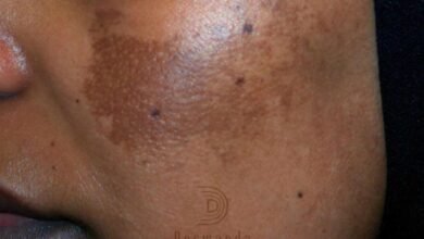 ‏Dermanda Clinic إسم رائد في علاج الكلف بمختلف أنواعه