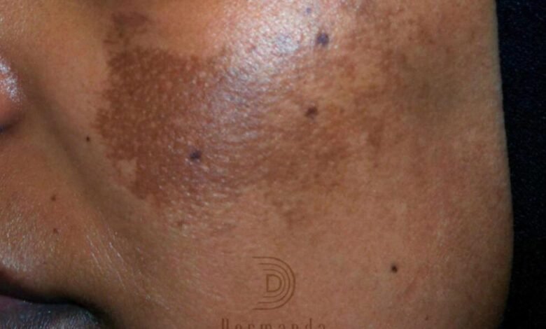‏Dermanda Clinic إسم رائد في علاج الكلف بمختلف أنواعه