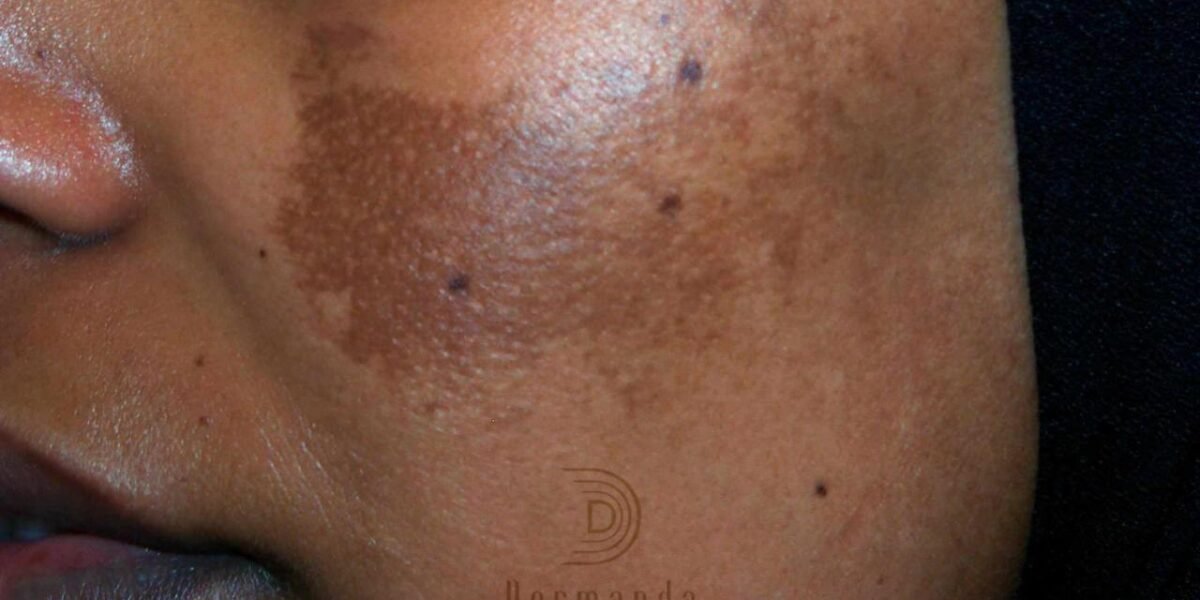 ‏Dermanda Clinic إسم رائد في علاج الكلف بمختلف أنواعه